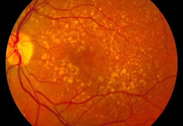 intermediate_age_related_macular_degeneration-610x420