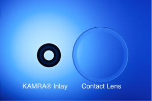 KAMRA Corneal Inlay | Treatment for Near Vision Loss | Whitten Laser Eye