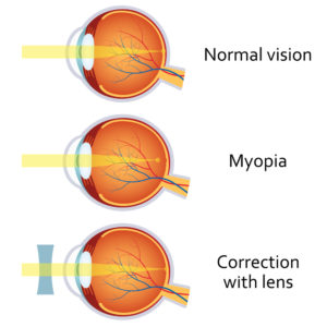 A rövidlátás (myopia) - Szakmai Informáciok - Pirinyó Szemészet - Gyermekszemészet